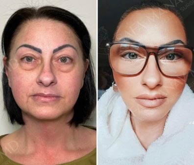 Face & Neck Lift & Combined Blepharoplasty