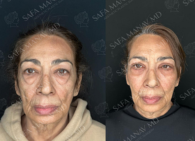 before-after2-1-e1696248124982-1.png
