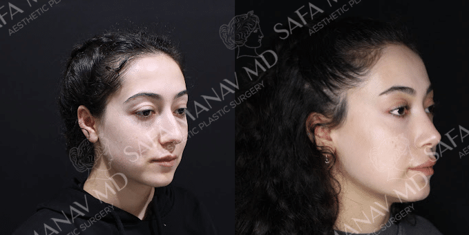 Rhinoplasty before and after