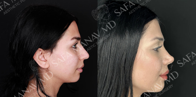 Rhinoplasty before and after photos