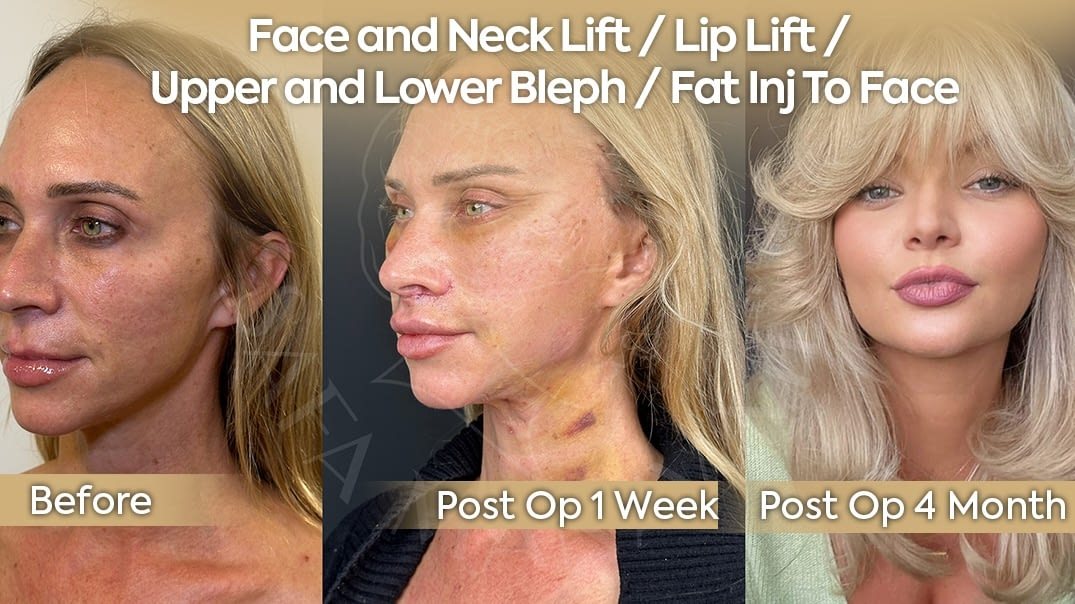 Deep Plane Facelift and Fat Injection Europe