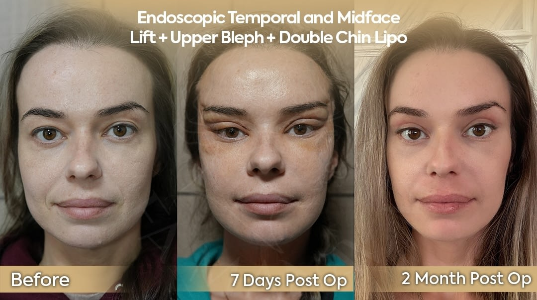 Endoscopic Midface Lift and Double Chin Lipo UK Patient