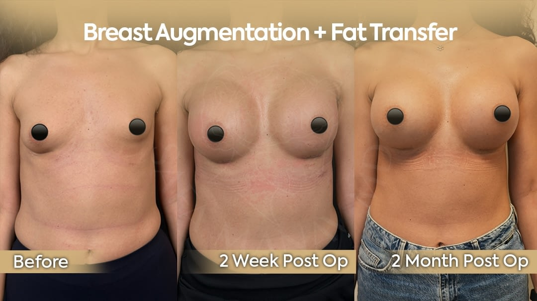 Breast Augmentation with Fat Transfer 2 Months Post Op