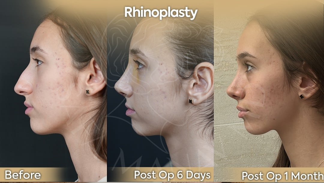 Rhinoplasty Profile Before and After UK