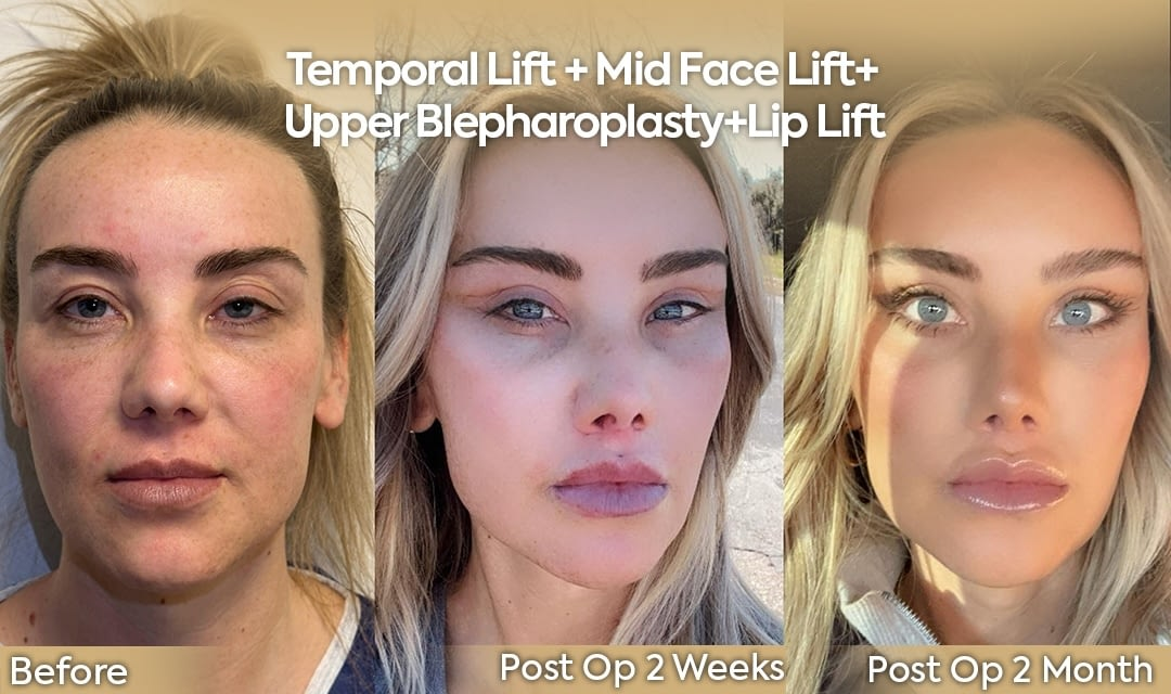 Temporal and Mid Face Lift Healing Process USA Patient