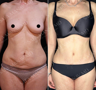 Abdominoplasty