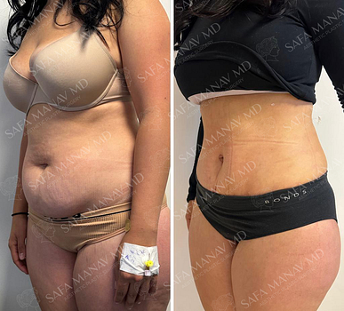 Abdominoplasty