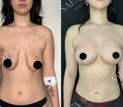 Breast lift with Implants