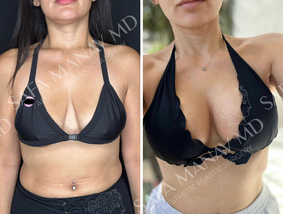 Breast lift with Implants
