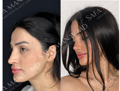 Secondary Rhinoplasty