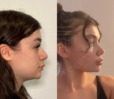 Rhinoplasty Op.