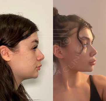 Rhinoplasty