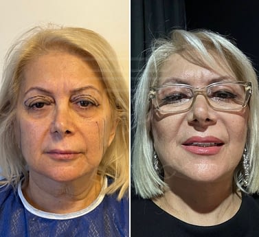 Face and Neck lift & Upper blepharoplasty &Fat injection to face