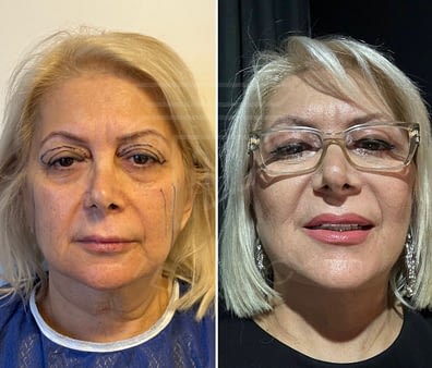 Face and Neck lift & Upper blepharoplasty &Fat injection to face