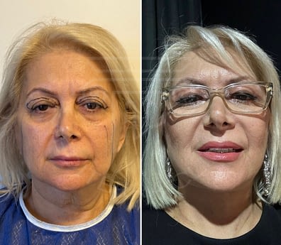 Face and Neck lift & Upper blepharoplasty &Fat injection to face