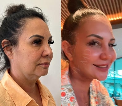 Facelift and Necklift