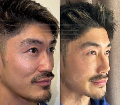 Rhinoplasty-Asian-Nose