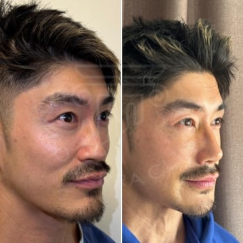 Rhinoplasty-Asian-Nose