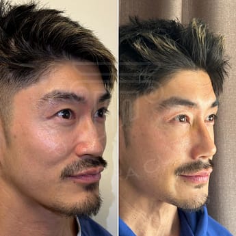 Rhinoplasty Asian Nose