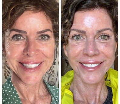 Face & Neck Lift & Fat Transfer to Face