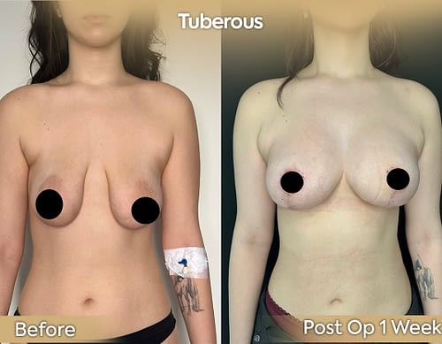 tuberous111