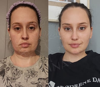 Temporal facelift & Buccal fat removal & Double chin liposuction