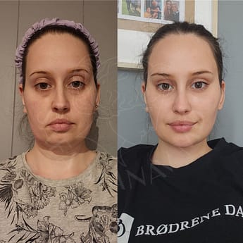 Face and Neck lift