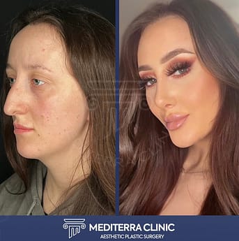 Rhinoplasty