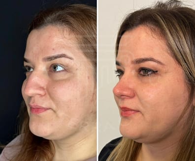 Rhinoplasty