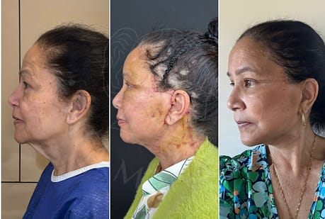 Face Lift Process