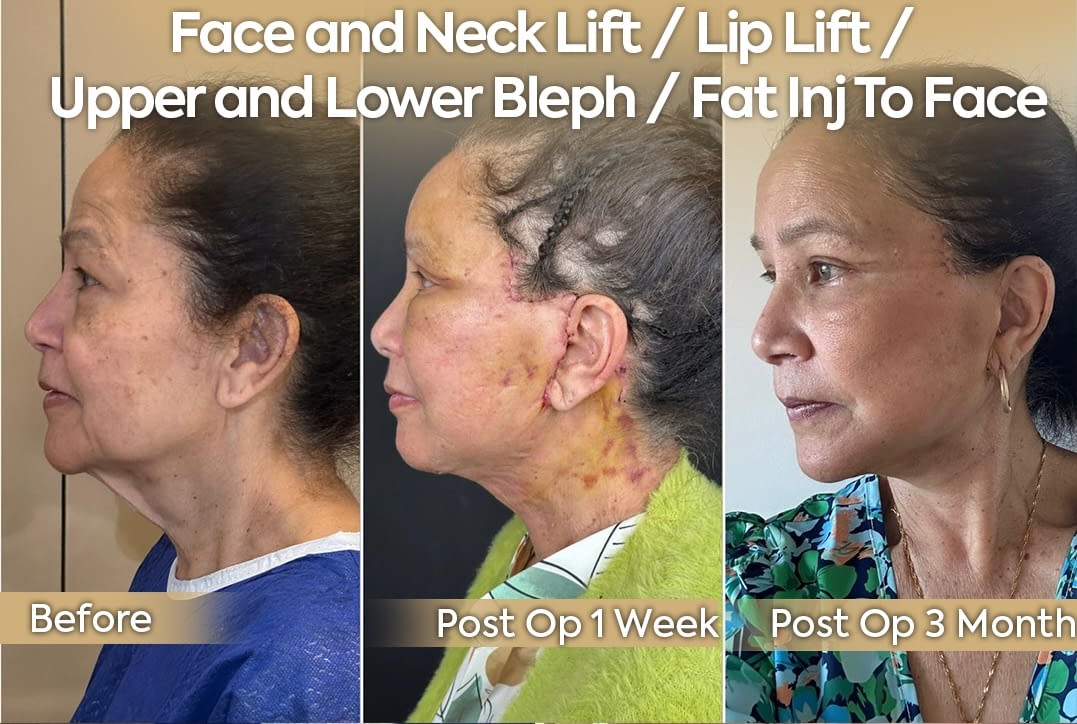 Comprehensive deep plane face and neck lift with lip lift, upper and lower blepharoplasty, and fat injection transformation for Miami USA patient by Dr. Safa Manav Clinic