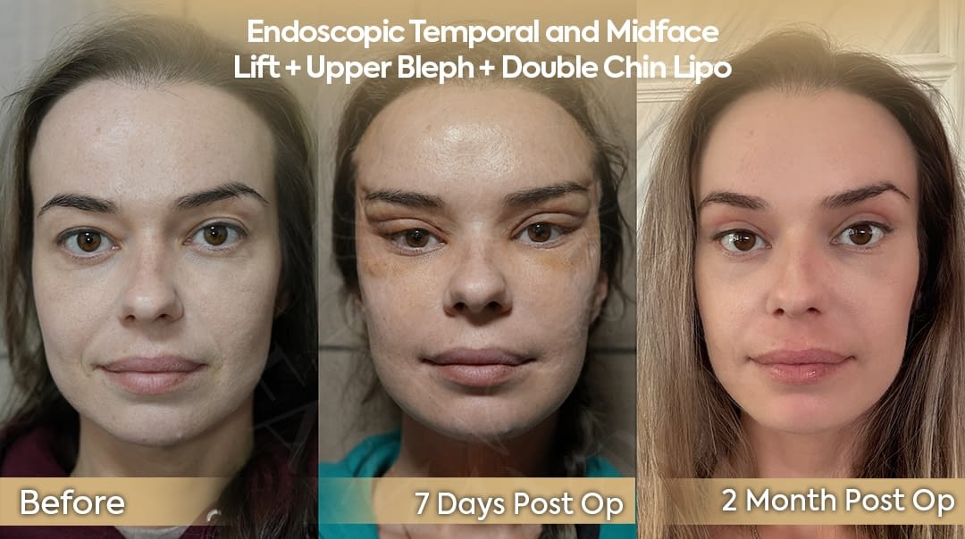 Endoscopic temporal and midface lift with upper blepharoplasty and double chin liposuction recovery before and after for New York USA patient at Dr. Safa Manav Clinic