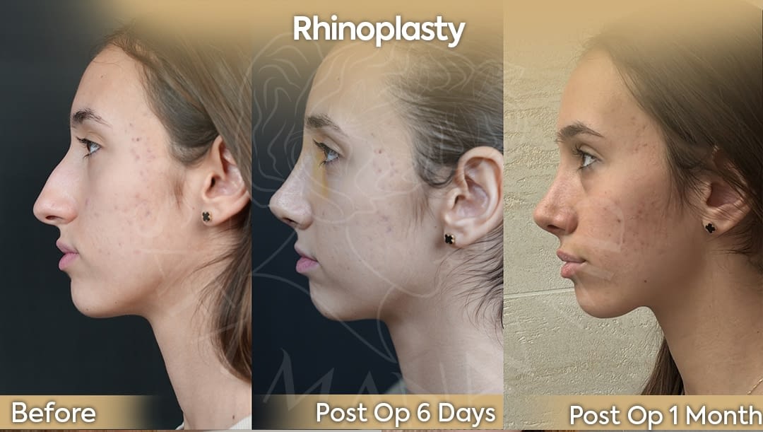 Female aesthetic rhinoplasty profile 6 days post-op early healing process before and after nose job results for Texas USA patient at Dr. Safa Manav Clinic Turkey