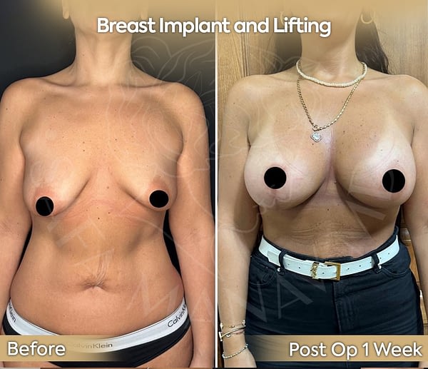 breastbest