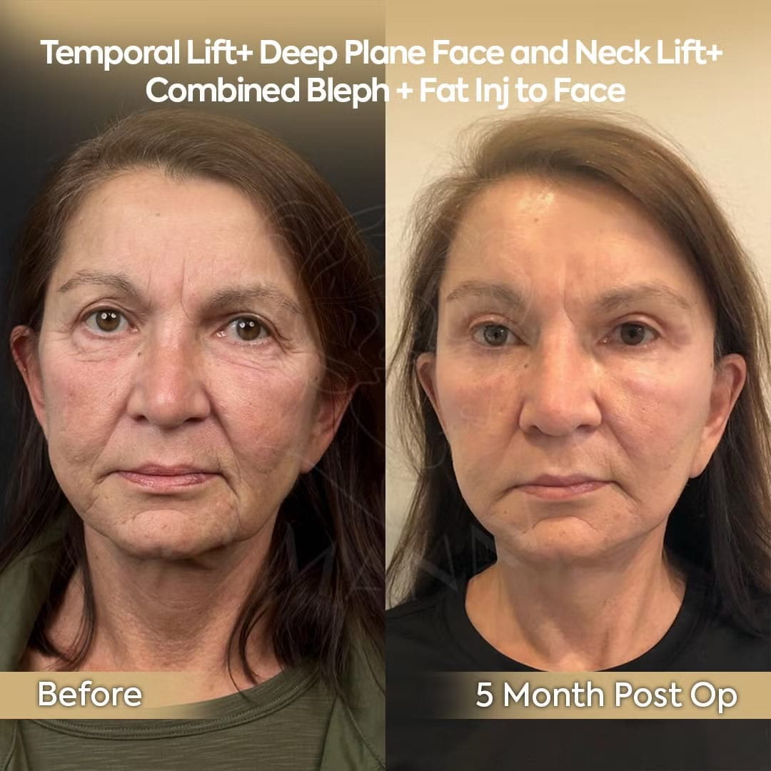 Facial Rejuvenation Patient from Boston