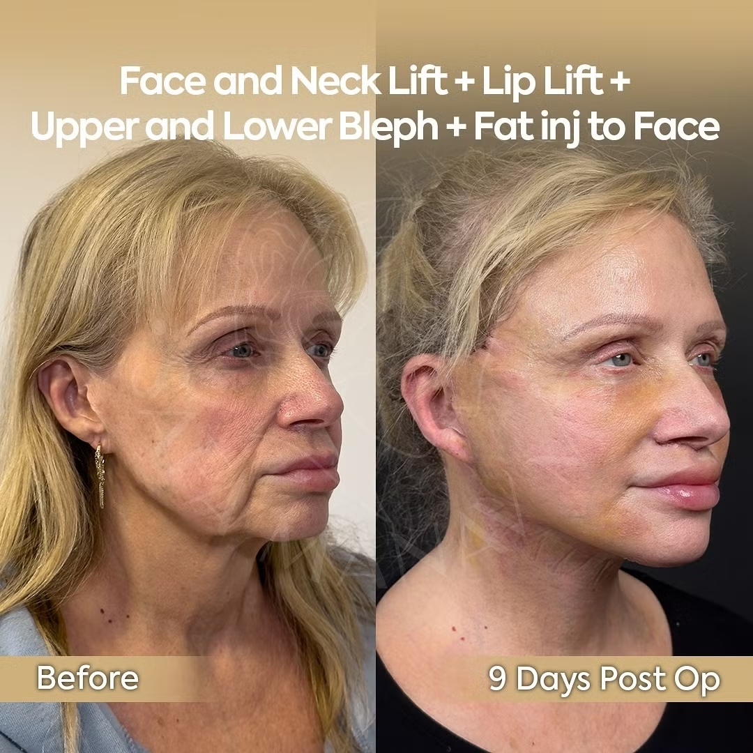 Facial Rejuvenation Patient from Chicago