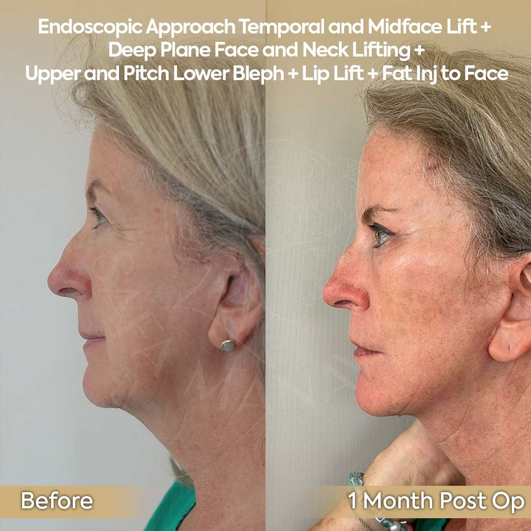 Endoscopic Midface and Deep Plane Neck Lift UK