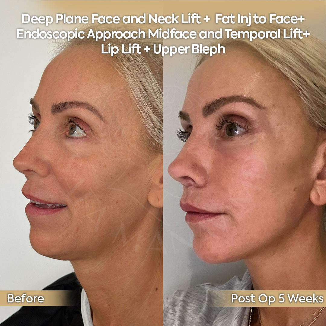 Facial Rejuvenation Patient from New Jersey