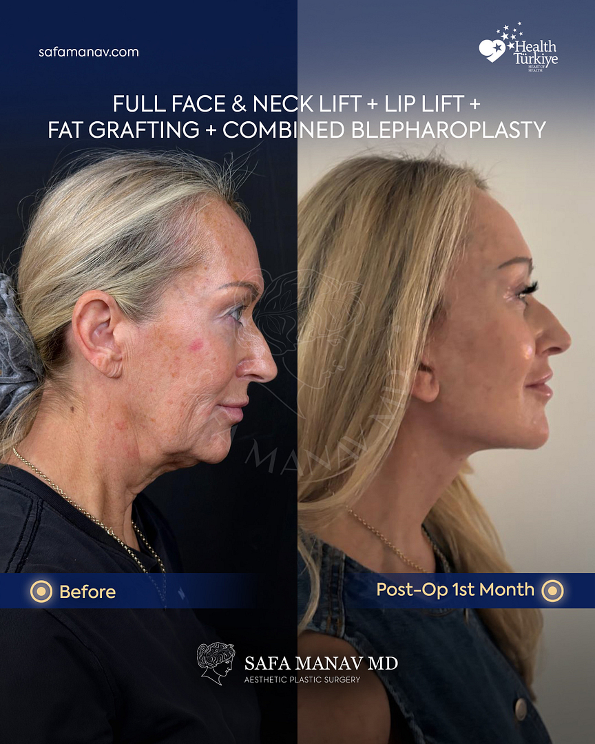 Face and Necklift USA with Dr. Safa Manav