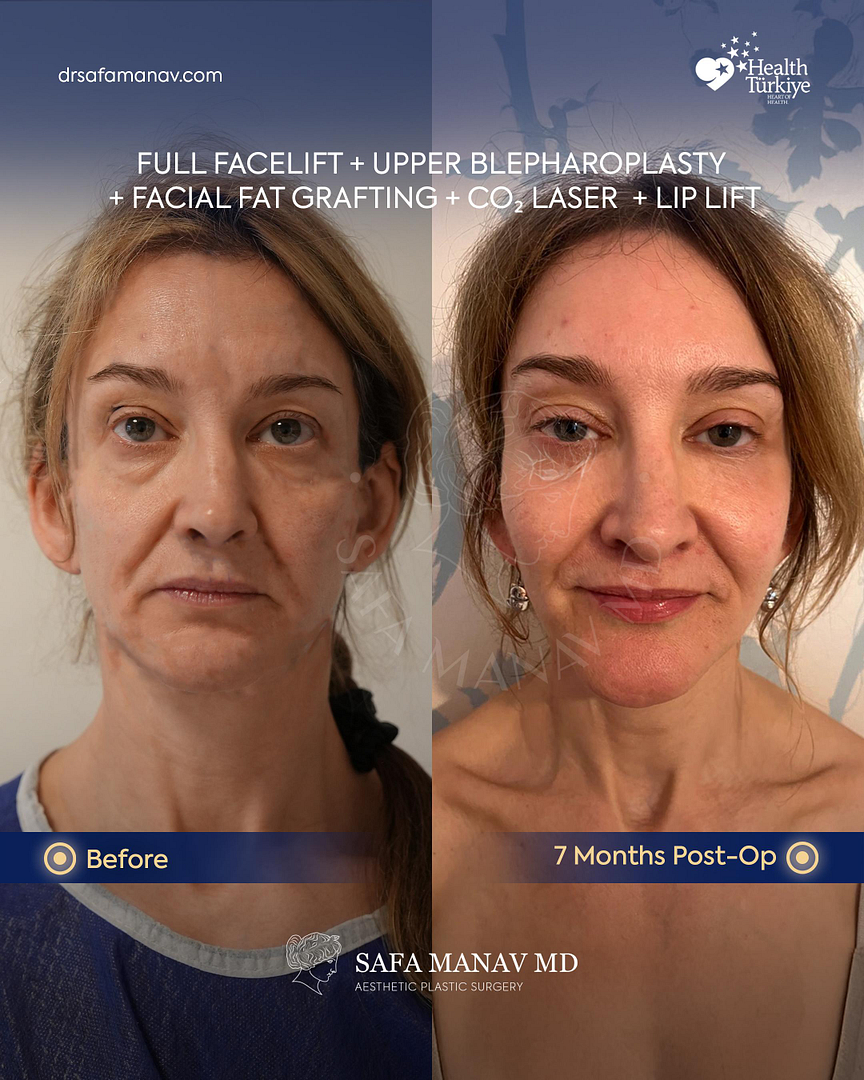Face and Necklift New York with Dr. Safa Manav